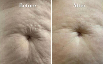 Mummy tummy treatment results and at home skin care tips